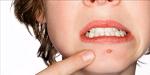 Myths About Pimples